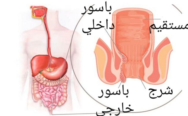 اعراض البواسير الداخلية عند النساء