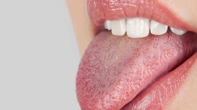 ما هي اعراض متلازمة الفم الحارق
