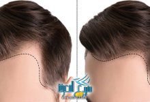 كل ما تحتاج معرفته عن أسعار زراعة الشعر في مصر