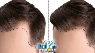 كل ما تحتاج معرفته عن أسعار زراعة الشعر في مصر