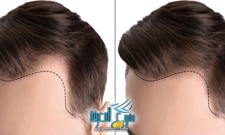كل ما تحتاج معرفته عن أسعار زراعة الشعر في مصر